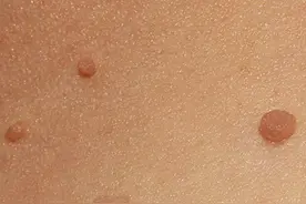 脖子和腋下的“肉球”是什么？可以自己处理吗？医生来告诉你答案图片