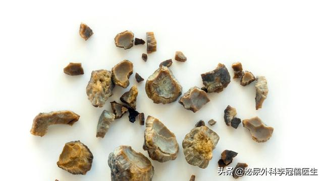 有多少人遭受了尿结石之痛?5个妙招破解尿路结石,避免复发