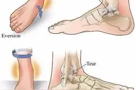 关于崴脚你应该知道的踝关节图片