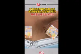 深圳一女童围观钓鱼，被鱼钩钩住眼皮图片