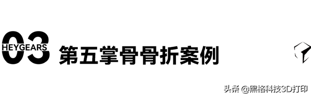 打了石膏痒怎么办