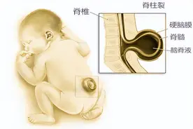 隐藏在“小尾巴”里面的秘密——脊柱裂！图片