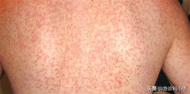 手上长了很多小红点