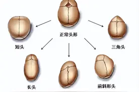孩子头型异常一定要引起重视图片