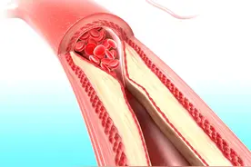 2亿国人有颈动脉斑块！别急着吃他汀，做好这5点，或可“逆转”图片