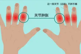 类风湿关节炎，早期啥症状？怎么治？图片