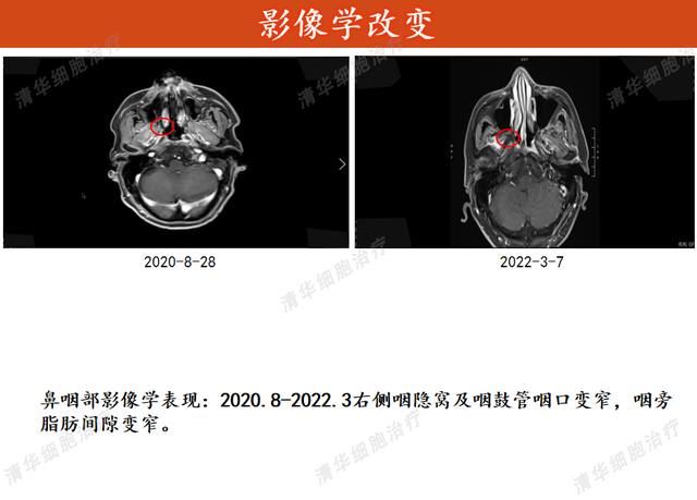 非角化型鳞状细胞癌的药物治疗