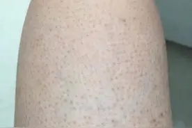 颜次方小知识：鸡皮肤的姐妹如何自救图片