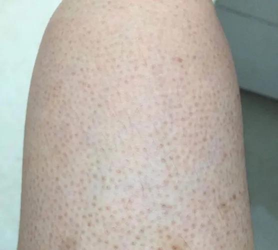 粗糙鸡皮肤女孩变得精致光滑