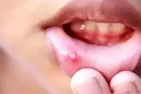 口腔溃疡不都是上火了，更多的是亏虚图片