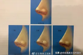 鼻翼缘退缩要如何矫正 | 王旭彬隆鼻图片