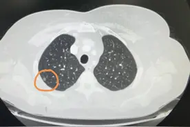 刘懿博士说肺癌（五六一八）刚发现6mm肺磨玻璃结节，坚决要手术图片