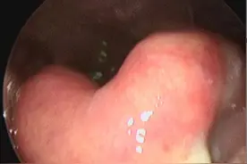 咽喉痛，吞咽困难，莫大意图片