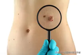 你身上有痣吗？长什么地方的痣要当心！哪些痣会癌变，如何分辨图片