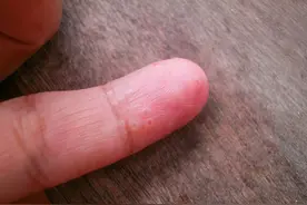 手上长小水泡越挠越痒，是脚气传染到手上了？提醒：要注意鉴别图片