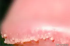 男性尖锐湿疣与假性湿疣区别图片