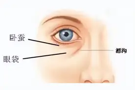 如何区分卧蚕和眼袋？图片