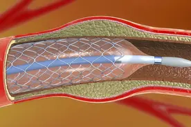 装上“心脏支架”后，还能活多少年呢？来听听医生的解释图片