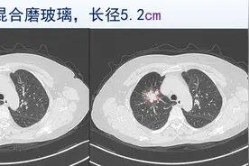 看3个肺癌CT，效果挺好，看完就不恐癌了图片
