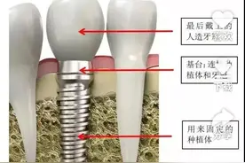 我种牙的过程及感受图片