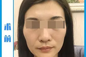 38岁做拉皮，术后37天几张实拍照记录下点点滴滴，老公夸她变化大图片
