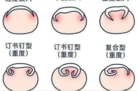 趾甲长到肉里怎么办？图片