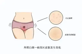 新技术治疗难言之隐的“外阴白斑”图片
