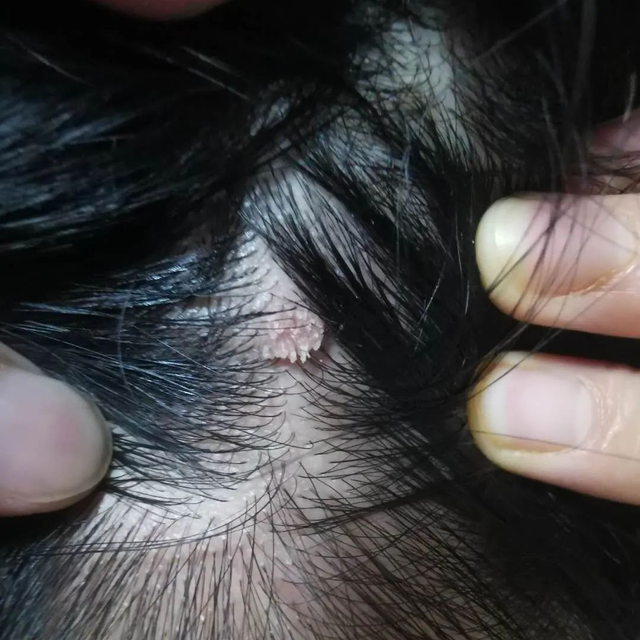 角化棘皮瘤的病理要点