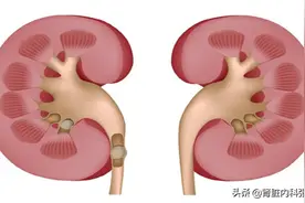 肾结石，为什么总爱夜间发作？医生直言：与这两个方面有关图片