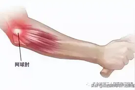 二院科普｜“网球肘”并非网球运动员的“专利”图片