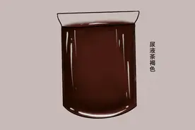尿液颜色异常，暗示身体有疾？小便后发现6种异样，建议及时检查图片