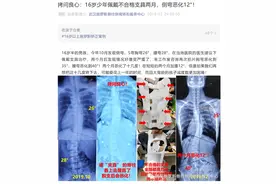 别让不合格支具耽误了孩子的脊柱侧弯矫正！图片