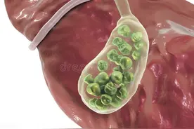 体检时发现胆结石，胆囊到底切不切？北大专家给出了答案图片