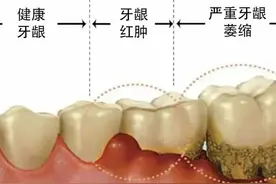 牙龈萎缩要警惕，对号入座早干预！图片