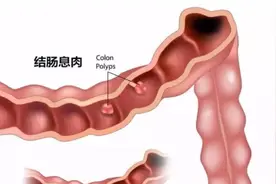 别把肠息肉拖成肠癌！医生忠告：肠内长了息肉，身体会有3种异常图片