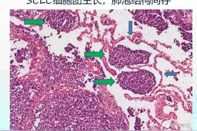 得了小细胞肺癌怎么办？小细胞肺癌应该怎么治疗？图片