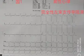 完全性左束支传导阻滞图片