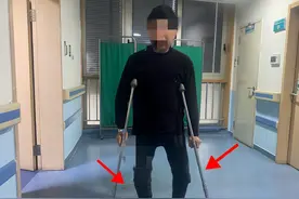 六旬老人膝盖疼痛如针刺，六年弯成“O形腿”，换个关节帮到他图片