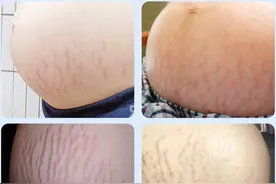 同样是怀孕当妈，为何有些孕妈不长妊娠纹？体质到底有啥区别？图片