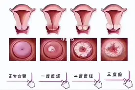 宫颈糜烂是正常生理现象？需不需要格外治疗？望知晓图片