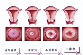 宫颈糜烂是正常生理现象？需不需要格外治疗？望知晓图片