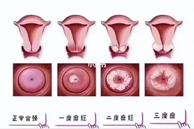 宫颈糜烂是正常生理现象？需不需要格外治疗？望知晓图片