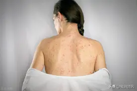 梅毒的治疗进展图片