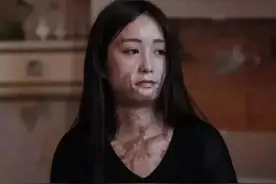 被泼硫酸非常可怕，赶紧用大量清水冲洗30分钟，作用太大了！图片