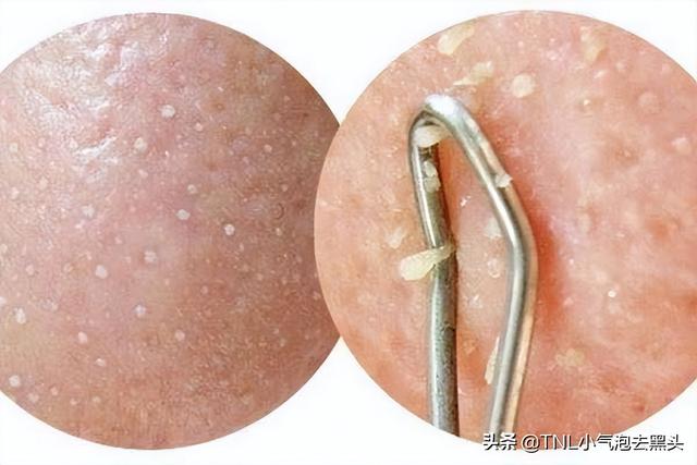 龟头上起白色脂肪粒