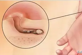 查明原因，彻底治疗疥疮图片