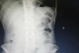 夺人生命的腹痛【消化道穿孔】图片