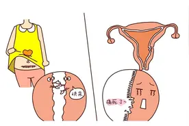 剖宫产刚几个月又怀孕了，这个宝宝还能要吗？图片