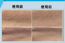 用1个月细纹就消失？A醇这效果是可以说的吗？图片