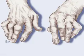 患者问：尿酸已经很低了，为什么还痛风？医生表示：说不定是好事图片